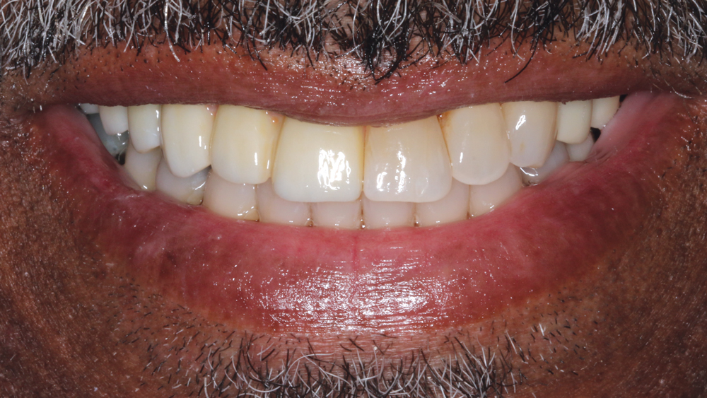 Figures 15a, 15b: The desired smile design was achieved, and the patient was thrilled with the functional and esthetic final result.