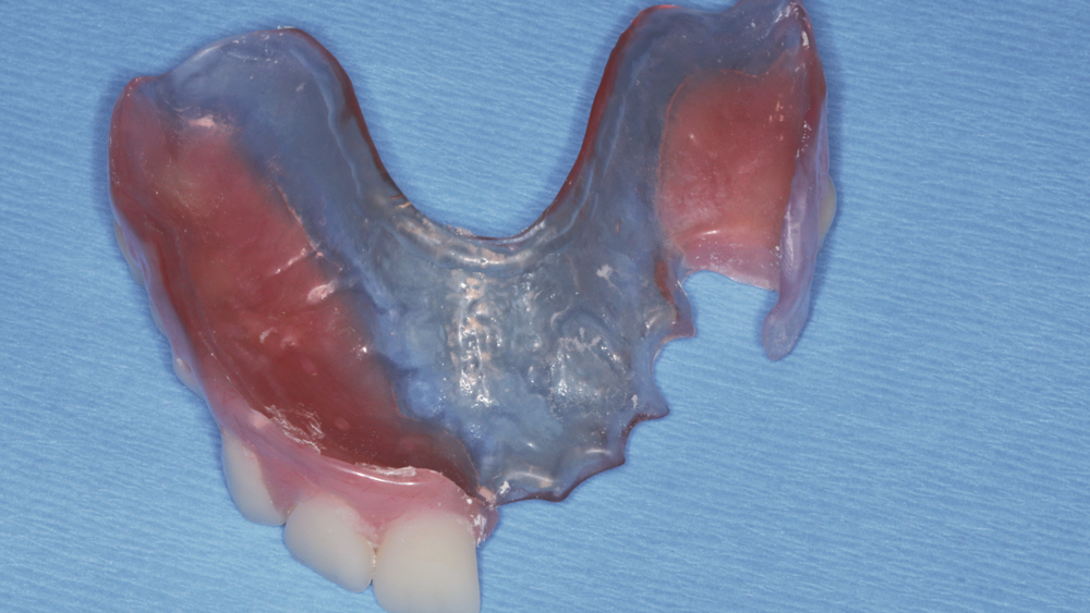 Figure 3: The laboratory fabricated a removable appliance to be seated following extraction and implant placement for use during the period of osseointegration.