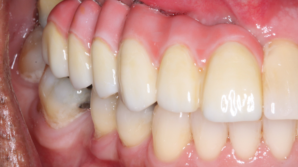 Figures 14b: The final BruxZir Solid Zirconia prosthesis was seated and evaluated.
