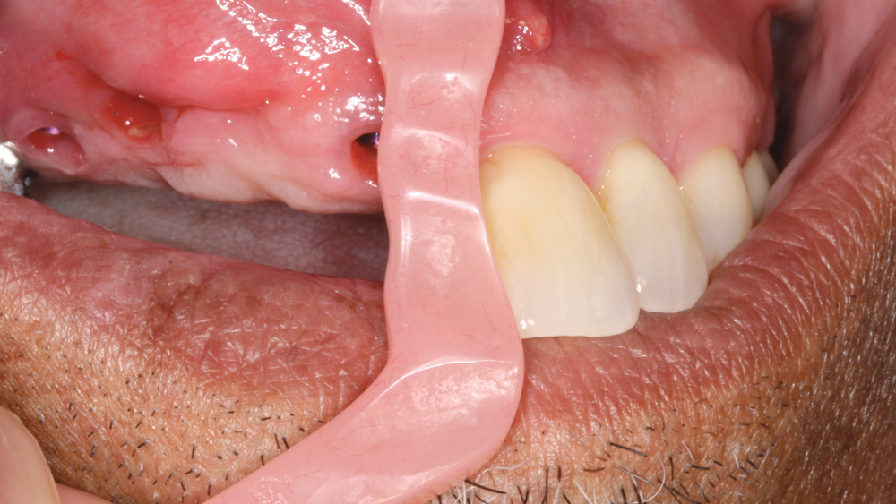 Figures 13b: Because of the excessive vertical bone loss created by the periodontally involved teeth, it was determined that the final BruxZir Solid Zirconia prosthesis would be designed and milled with gingival areas and pink coloring to maximize esthetics. A gingival shade guide was used to select the proper shade for the soft-tissue portion of the prosthesis.