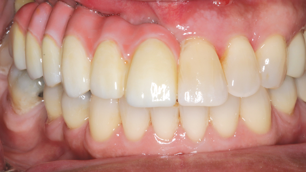 Figures 14a: The final BruxZir Solid Zirconia prosthesis was seated and evaluated.