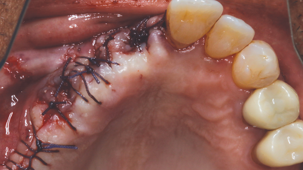Figure 8: VICRYL™ suture (Ethicon; Somerville, N.J.) was used to close the reflected gingival tissue.