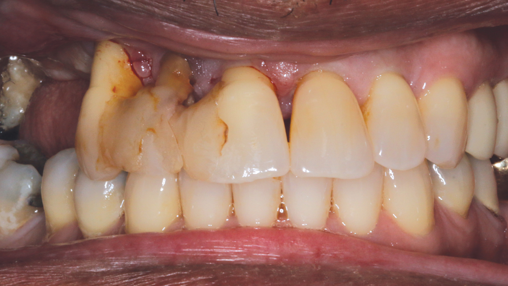Figure 1: Preoperative and retracted view of the periodontally involved and non-restorable maxillary right teeth #2–8.