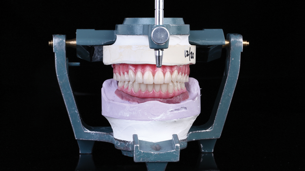 Advanced staining techniques were used to achieve consistent, lifelike gingival and tooth shades for the denture and implant prosthesis