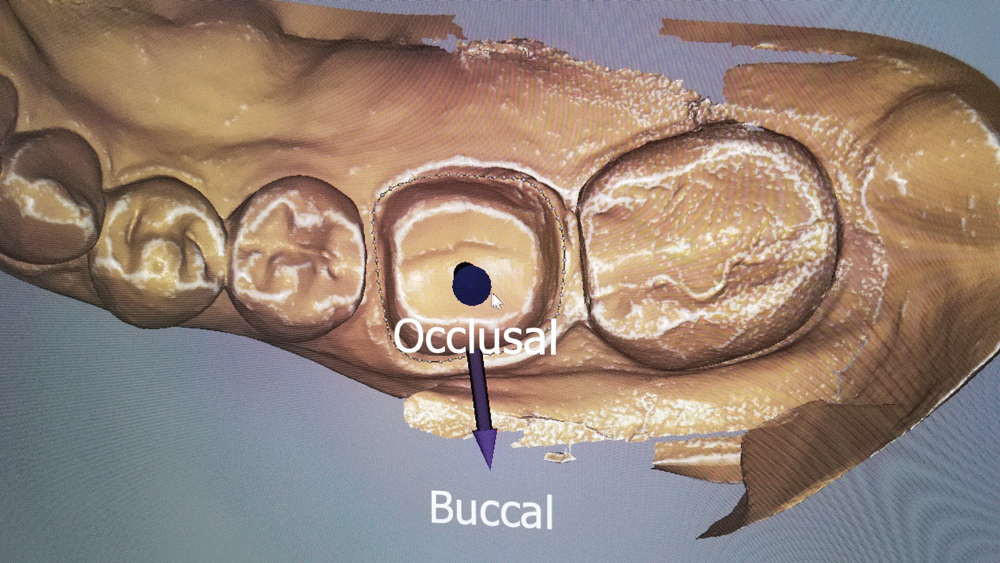occlusal and buccal aspects of the tooth preparation were identified using the fastdesign.io orientation tool