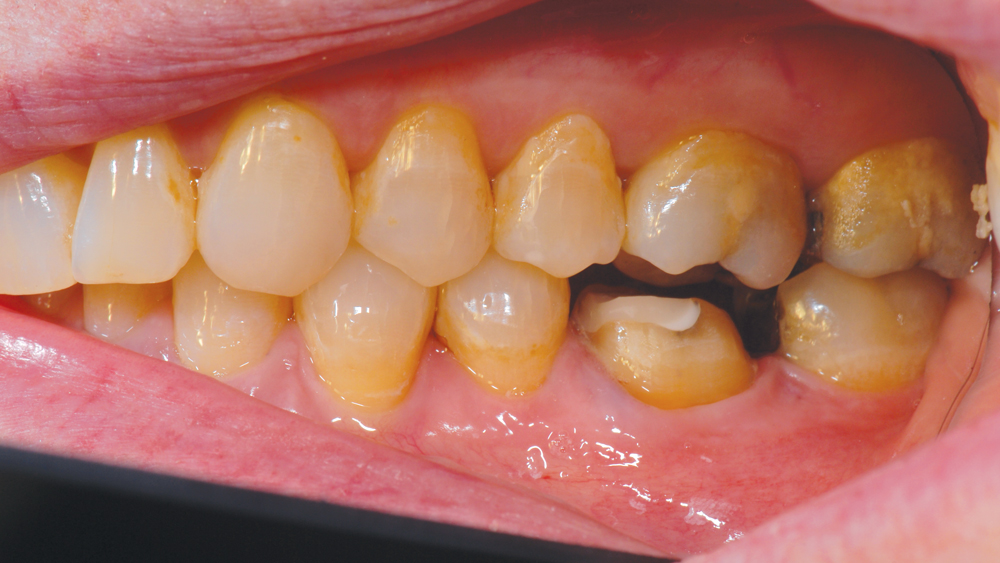 Lateral view of occlusal and buccal reduction on mandibular first molar