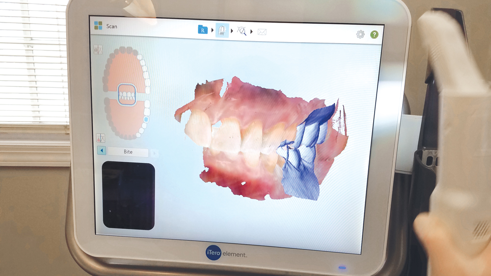 SingleAppointment Restorations Using the iTero Element® Scanner