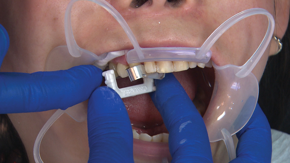 Dr. Muresan carefully relieves veneer contacts using the ContactEZ serrated strip