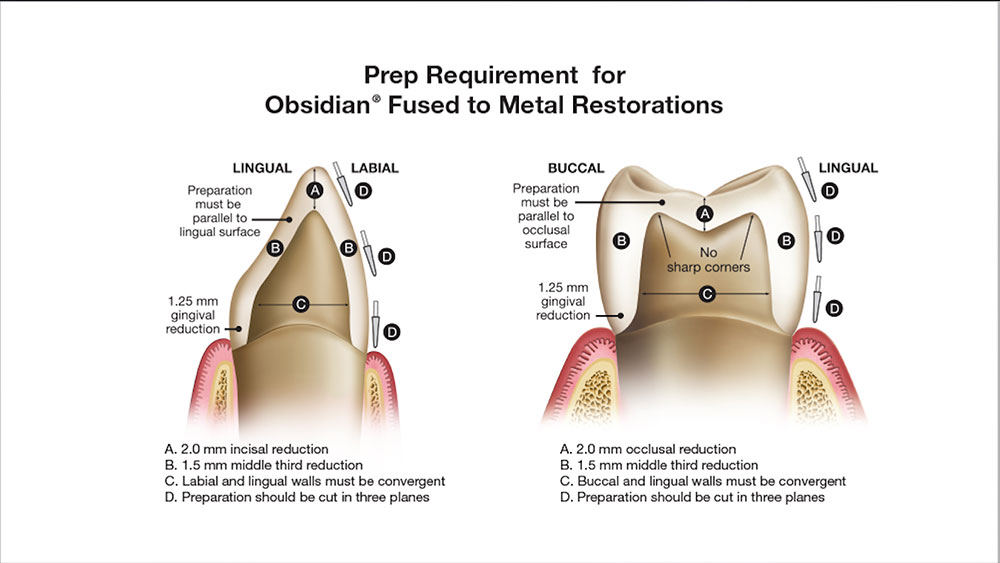 Prep Requirement for Obsidian Fused to Metal Restorations