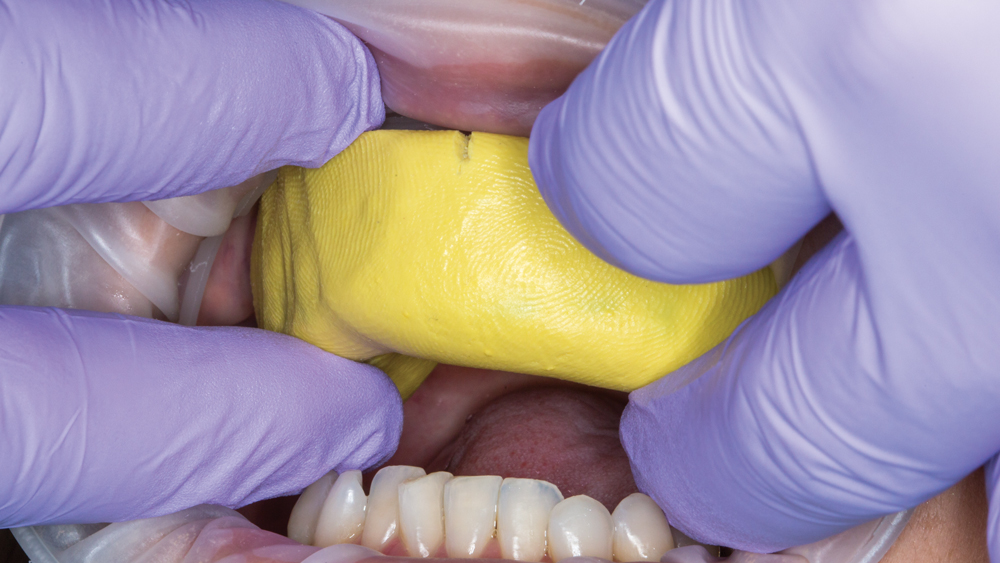 Doctor places mock-up over patient's upper teeth