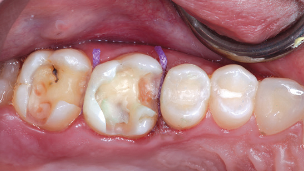 teeth #3
