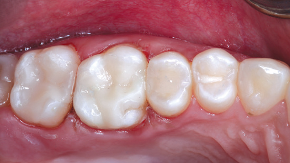 patient's fillings on teeth #2 and #3