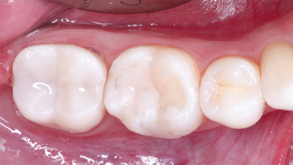CAMouflage NOW used here to restore teeth #30 and #31, and blended extremely well with the adjacent natural teeth