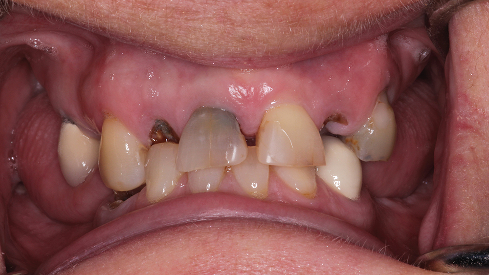 Intraoral view of maximum intercuspation shows severe teeth decay, periodontal breakdown, hyper-eruption and collapsed bite