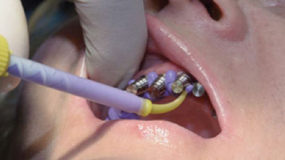 preliminary impression was made with open-tray transfer copings in place of patient's mouth