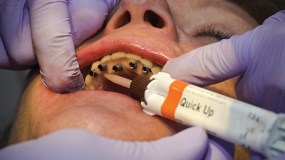 Quick Up, a self-curing denture relining material is being applied to temporary cylinders