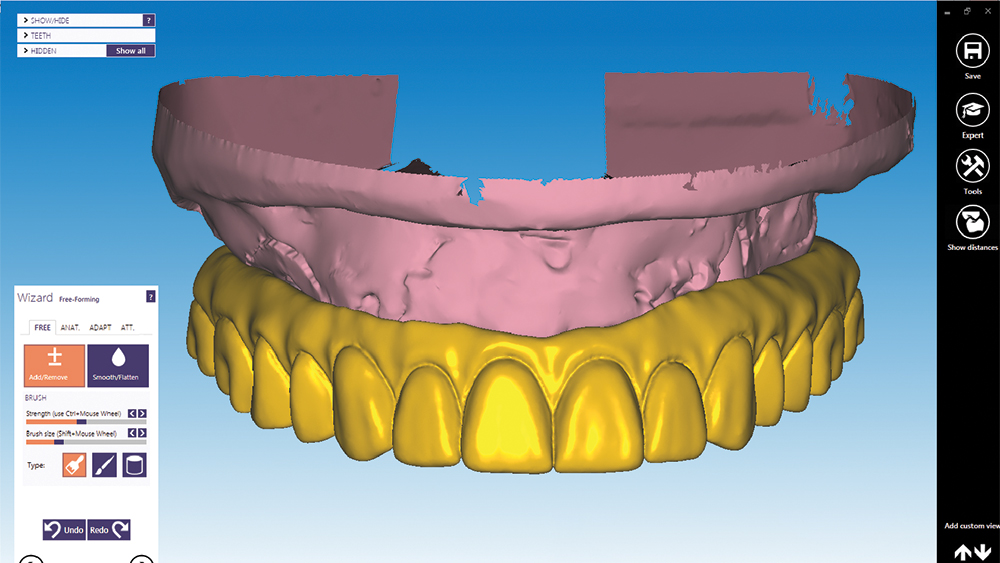 dental CAD software to utilize for initial design of BruxZir Full-Arch implant prosthesis