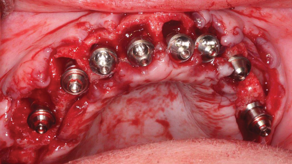  maxillary teeth were extracted and alveoplasty was performed