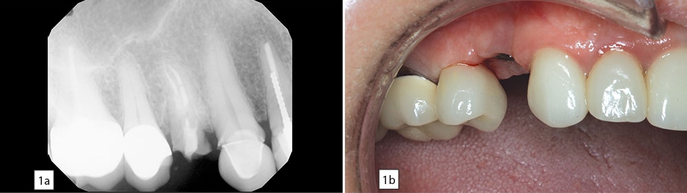 a maxillary premolar requiring extraction due to fracture