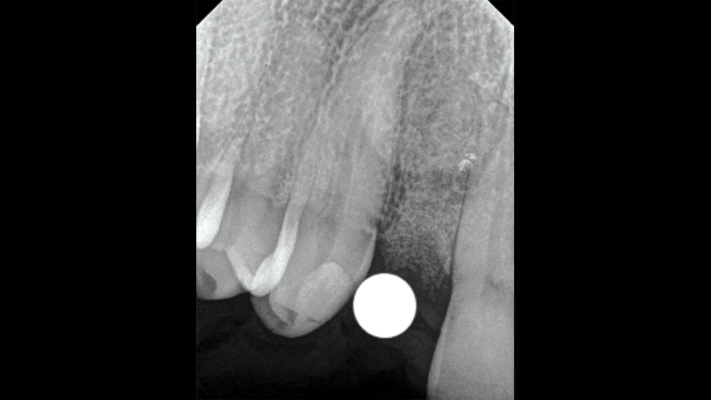 x-ray of the edentulous site