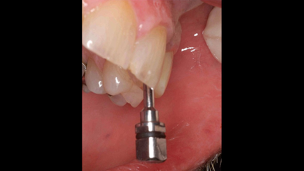 the driver used to deliver the healing abutment is positioned lingual to the incisal edge of the adjacent teeth