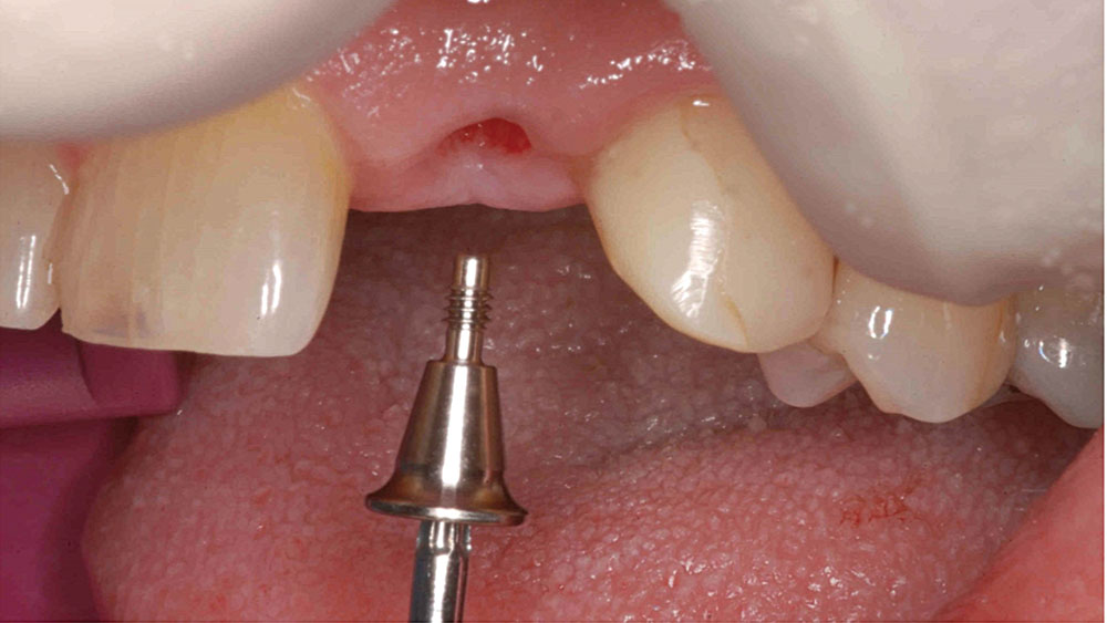 a healing abutment is connected to the implant