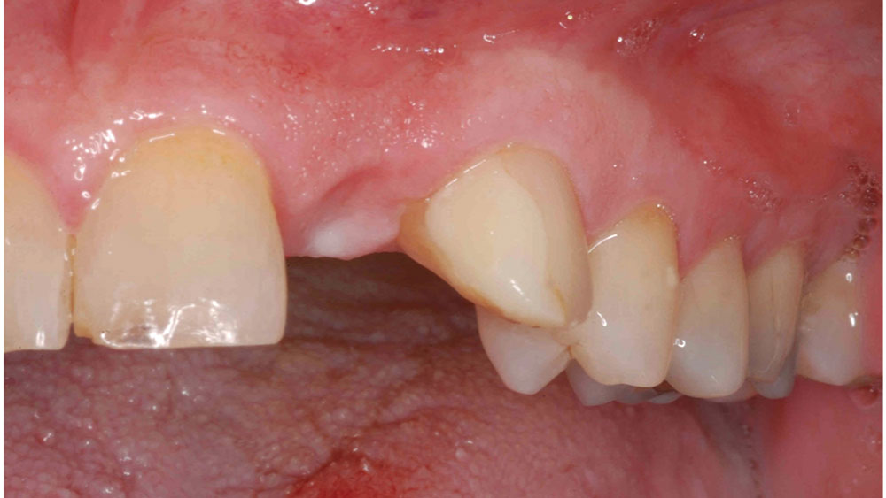 keratinized soft tissue and ample bone volume were present at the edentulous site