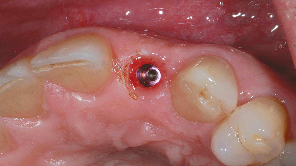 thick soft tissue surrounding implant site