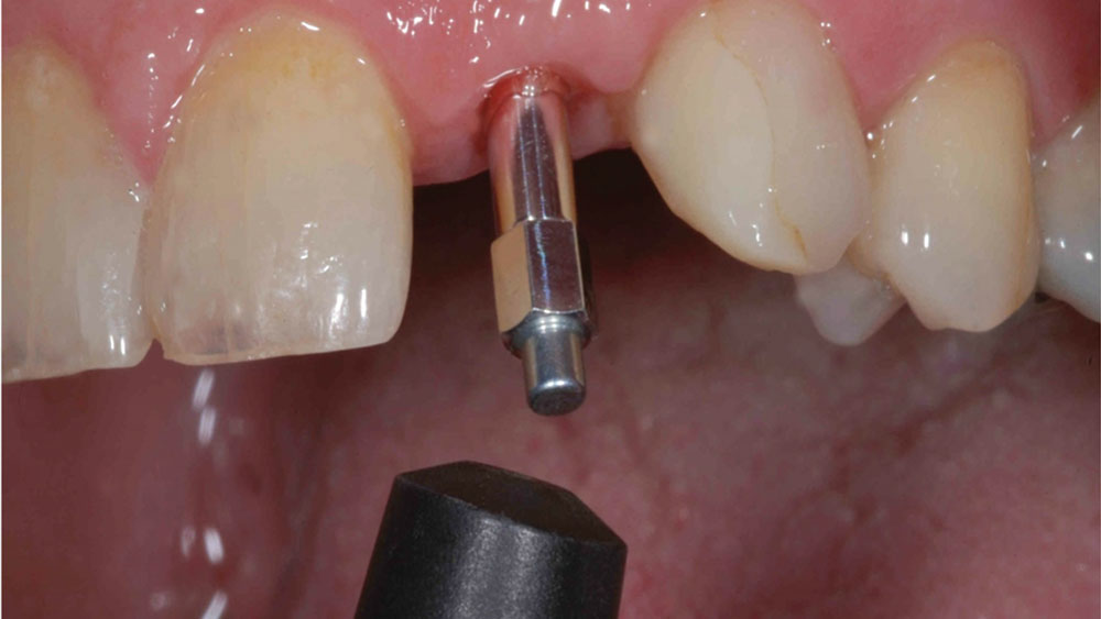 stability of implant is measured with Penguin RFA®