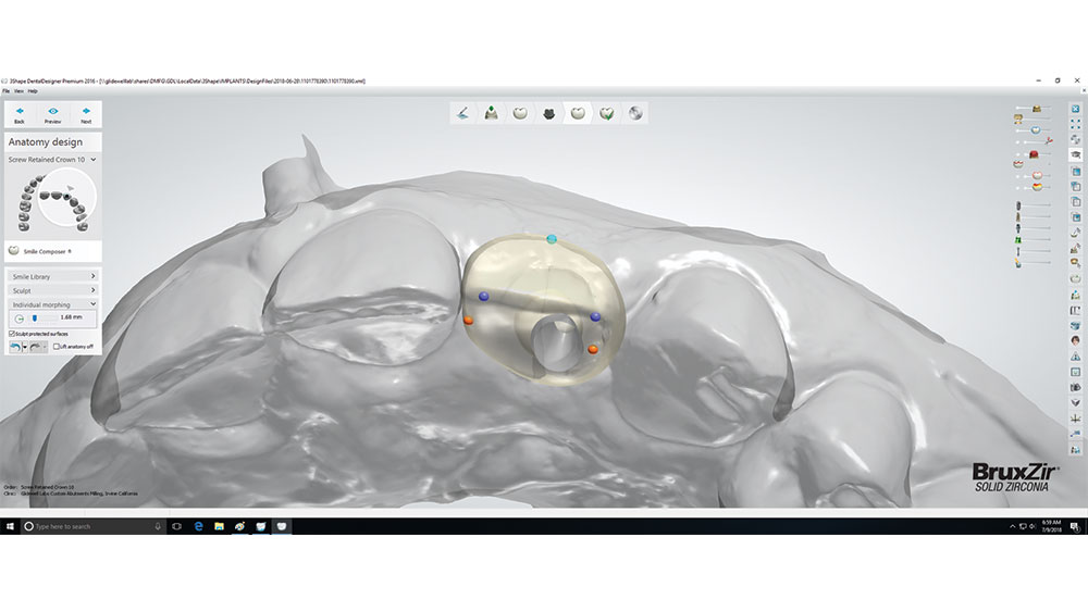 A digital impression was created using a TRIOS® intraoral scanner (3Shape North America; Warren, N.J.) and a Hahn Scanning Abutment (Glidewell Direct)