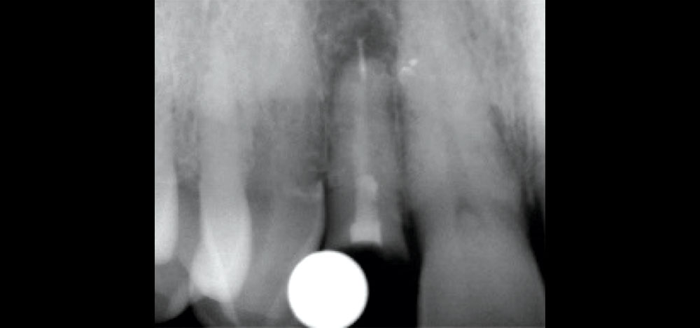 X-ray showing adequate bone volume and no interference from adjacent teeth or nearby anatomical structures