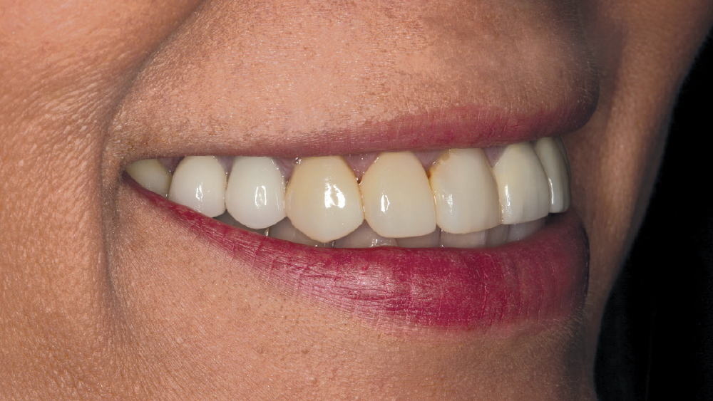 PFMs on teeth #4 and 5, IPS e.max veneers on teeth #6-8, #10 and #11