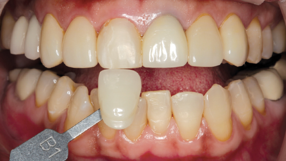 MulTipeg was mounted onto the Hahn Tapered Implant