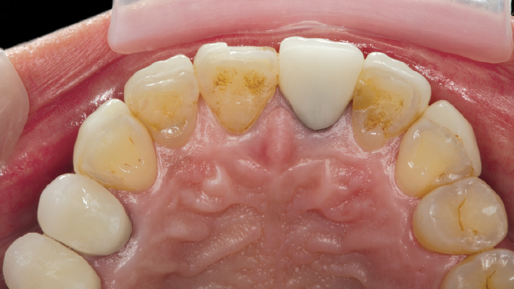 existing crown on tooth #9 did not blend well with the surrounding restorations 