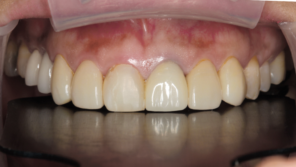 PFMs on teeth #4 and 5, IPS e.max veneers on teeth #6-8, #10 and #11