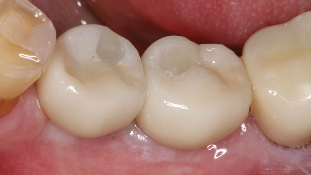 implant crowns