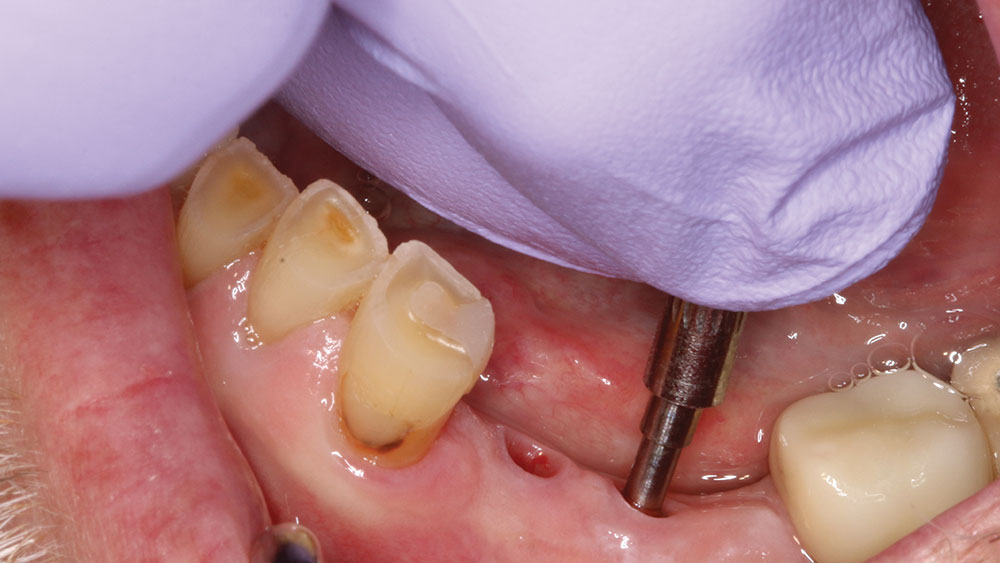  MulTipeg was mounted onto the Hahn Tapered Implant