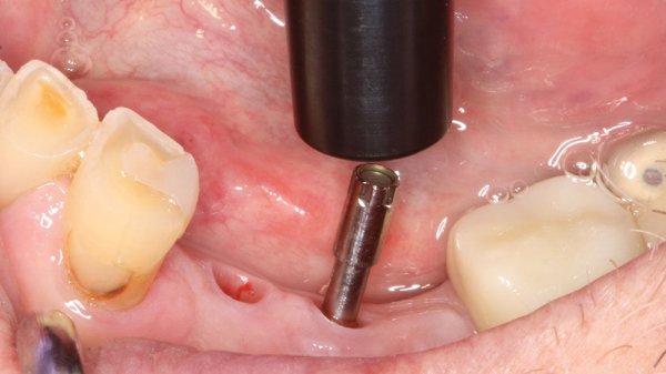 Penguin Rfa Product Spotlight: Penguin RFA® Determining Implant Stability with ...