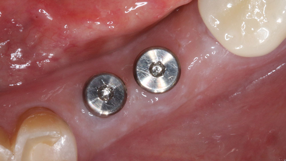 Hahn Tapered Implant surgical protocol