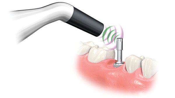 Penguin Rfa Product Spotlight: Penguin RFA® Determining Implant Stability with ...