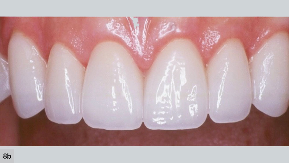 Patient’s upper left central incisor has too much anatomy and looks out of place next to the other ceramic restorations