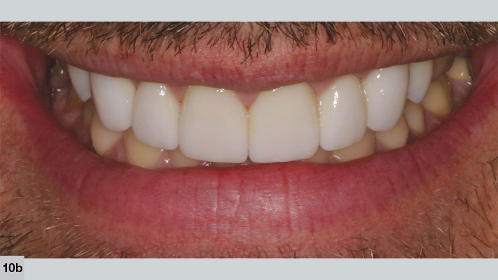 Lack of incisal translucency displays as artificial