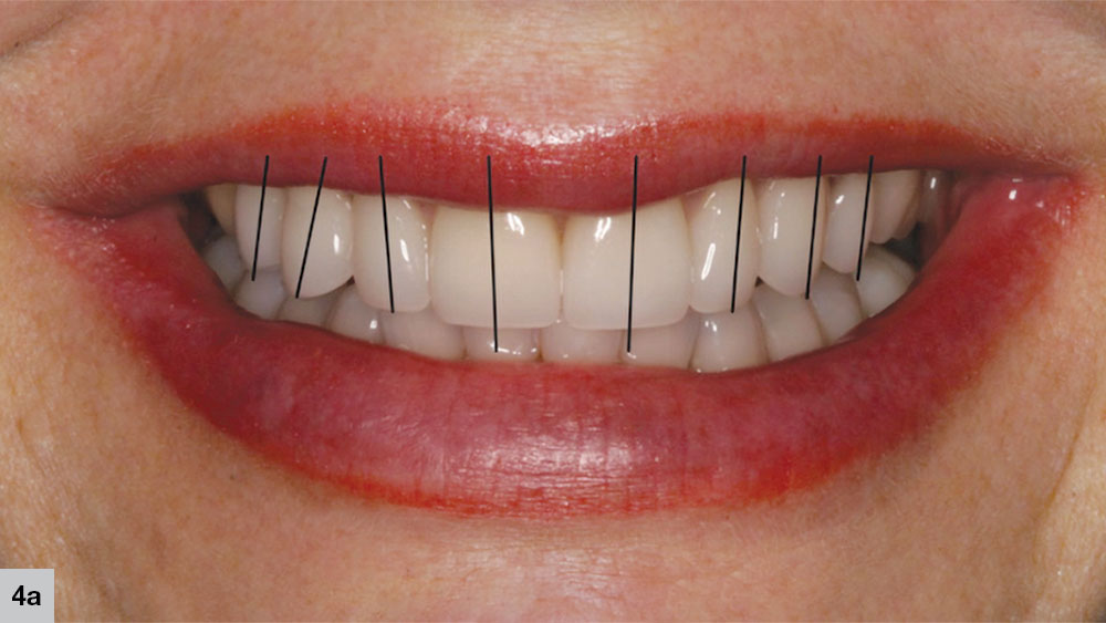 Teeth are tilted slightly toward the midline, except for the patient’s upper right first bicuspid and canine, drawing one’s attention to the teeth that are slightly out of position