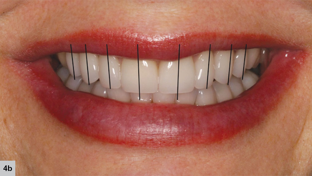Teeth all have a slight mesial cant toward the midline