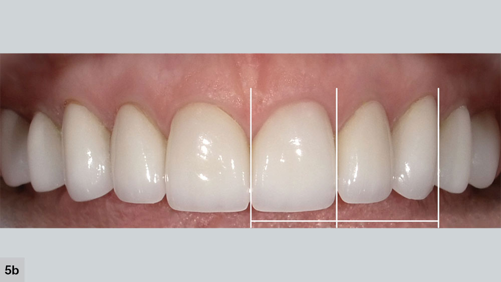 Altering this proportion so that the combined width of the lateral and canine is 15–20 percent wider than the central incisor is the key to natural, youthful smiles