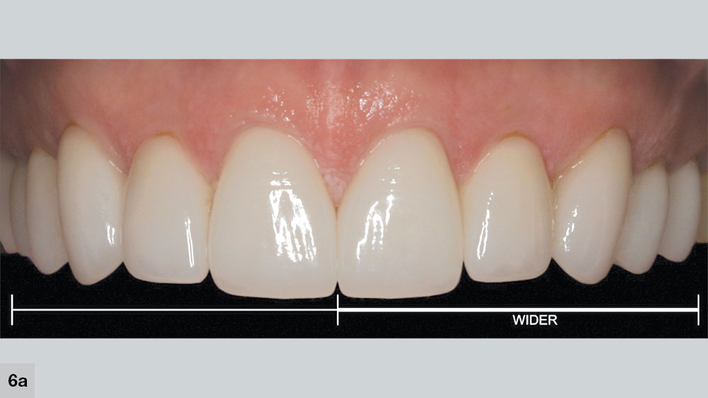 Patient’s left side is wider than the right, making the smile look unbalanced