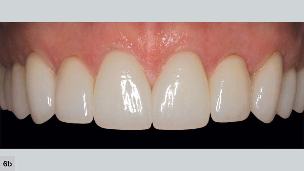 Patient's balance on both sides of the buccal corridor