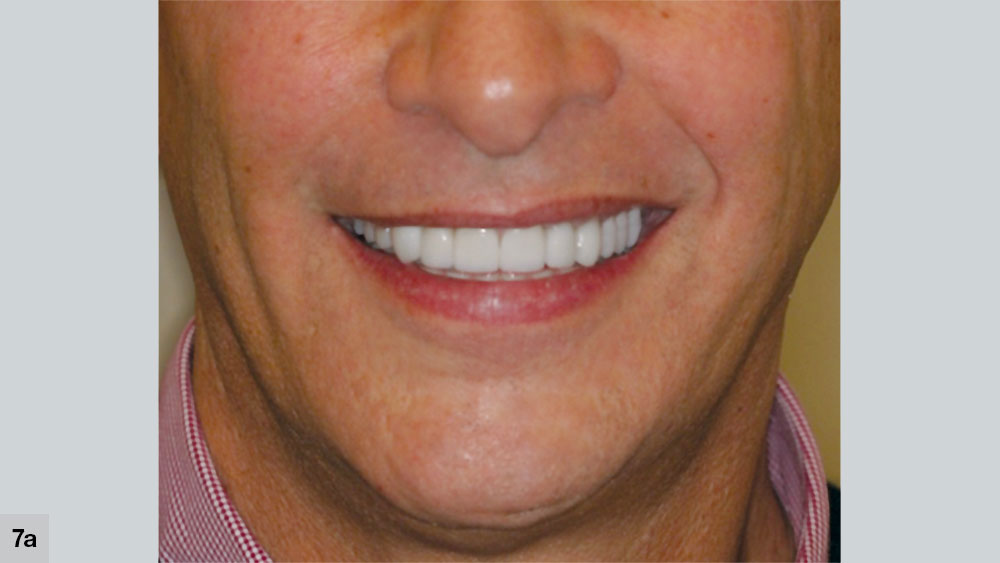 Smile with symmetrical curve of lower lip