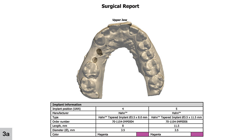 Surgical report of upper jaw