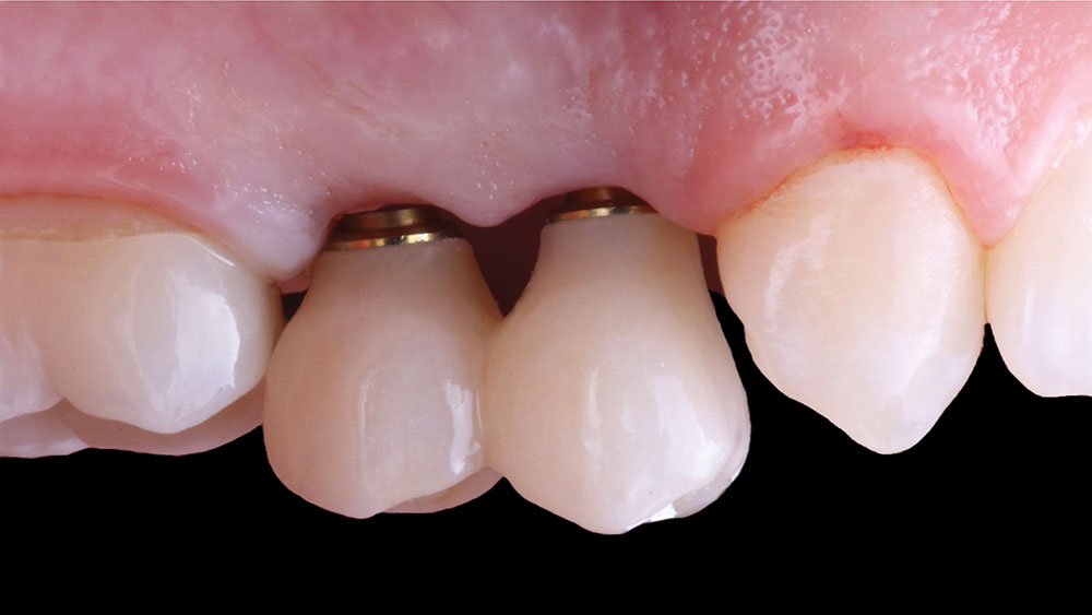 Screw-retained crowns added to patient's implant site